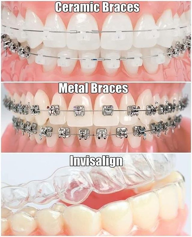 image showing ceramic braces, metal braces, and invisalign