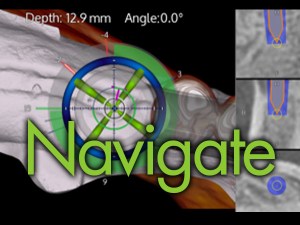 Surgical navigation interface displaying implant placement guidance with depth and angle measurements, labeled 
