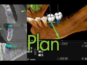 Digital implant treatment planning software showing virtual implant positioning in jaw, labeled 