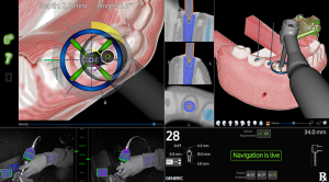 Multi-view guided surgery interface showing cross-sectional views and real-time navigation for dental implant placement