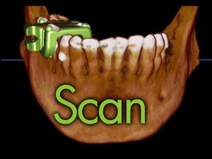 3D dental scan showing jaw with teeth and implant planning markers, labeled 