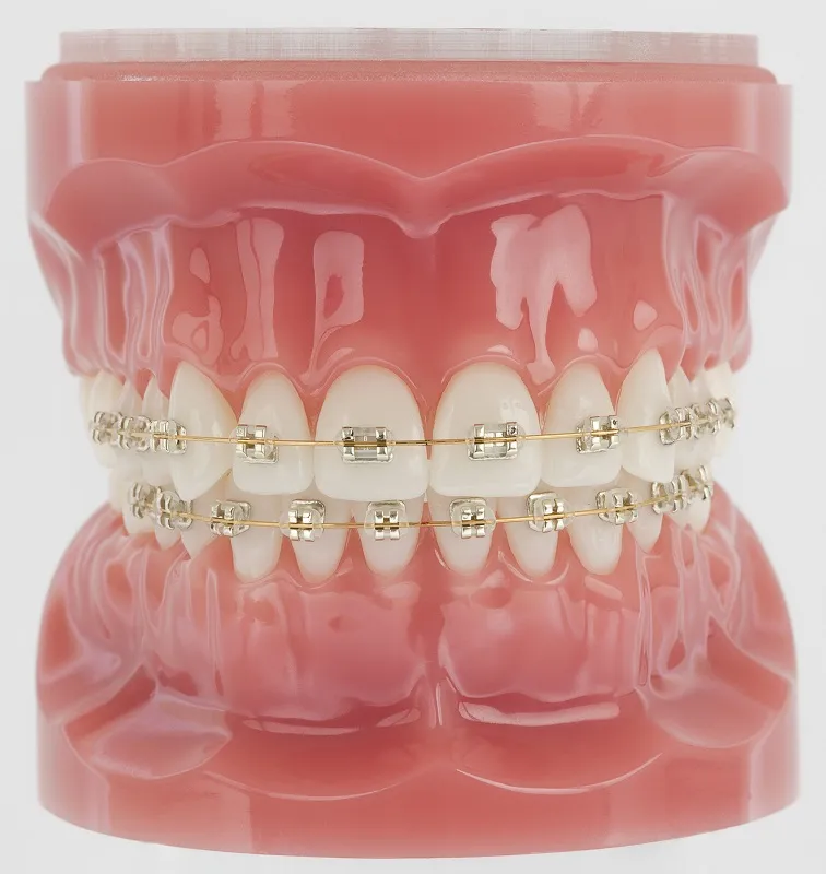 model of teeth with braces on them