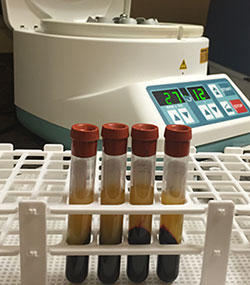 blood samples for PRF