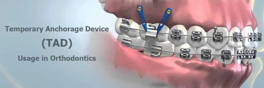 TAD usage in orthodontics