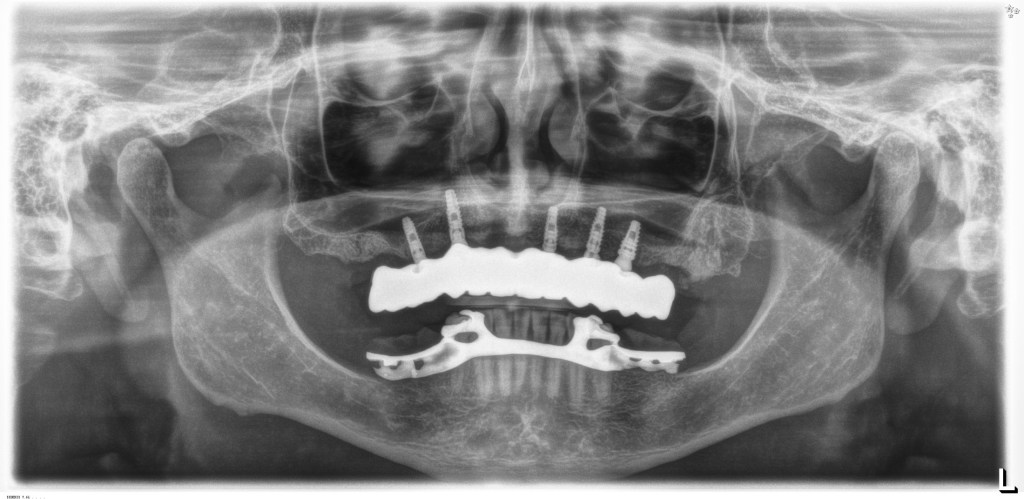 All on X Orlando | Full Arch Implants