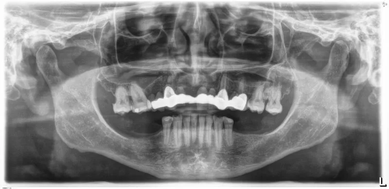 Panoramic dental X-ray showing before All-on-X procedure with missing teeth and compromised dental condition