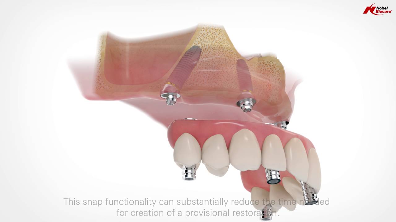 All-on-4 Treatment Concept | Nobel Biocare Video Thumbnail