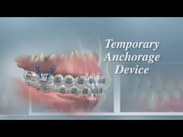 Temporary Anchorage Devices Video Thumbnail